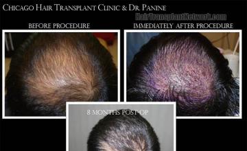 Hair restoration procedure before and after results