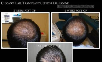 Hair transplantation surgery before and after photos