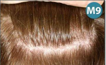 Hair restoration procedure results