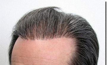 Hair restoration procedure results