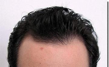 Hair restoration procedure results