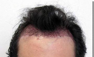 Hair restoration procedure results