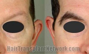 Front view - Before and after eyebrow transplant surgery