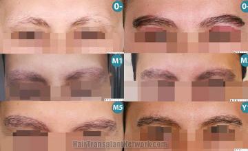 Front view - Before and after eyebrow restoration procedure