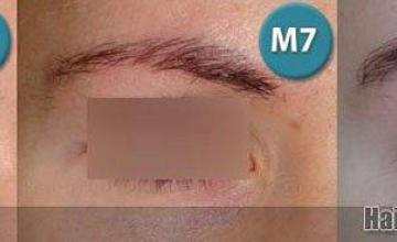Female eyebrow transplant results