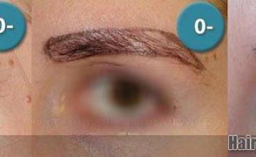 Eyebrow restoration results 