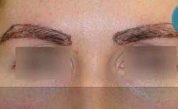 Female eyebrow transplant results
