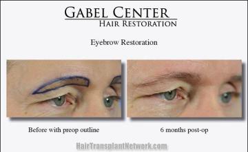 Eyebrow transplantation surgery before and after images