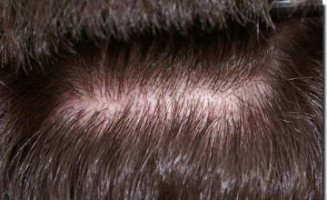 Hair restoration procedure results