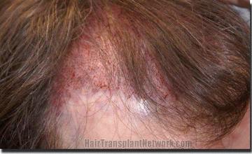 Hair restoration procedure results