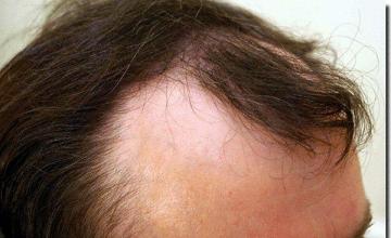 Hair restoration procedure results