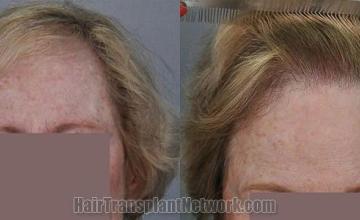 Female hair transplant surgery before and after photos