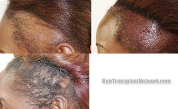 Hair transplantation surgery before and after pictures