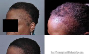 Hair transplantation surgery before and after pictures