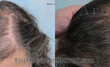 Female hair transplantation surgery result photographs