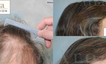 Before and after hair transplantation with a female patient