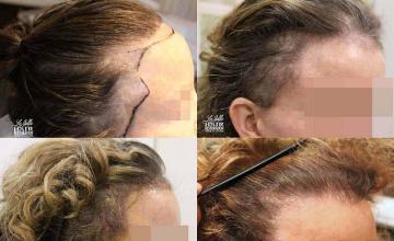 Hair restoration procedure before and after results