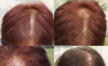 Female hair restoration  before and after photos