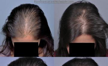 Top view before and after hair restoration results