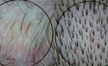 Hair transplant surgery donor hair supply images under the microscope