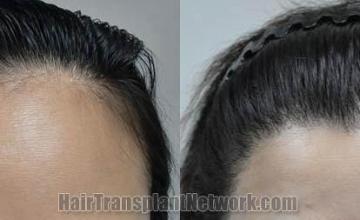 Hair restoration procedure before and after results