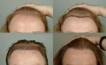 Hair transplantation surgery before and after images