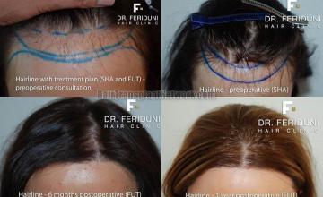 Hair transplantation surgery before and after pictures