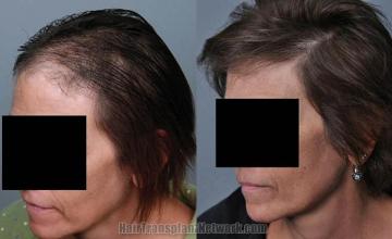 Hair transplantation surgery before and after images