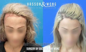 Female hair transplantation surgery before and after images