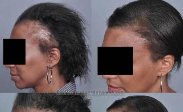 Hair transplantation surgery before and after pictures