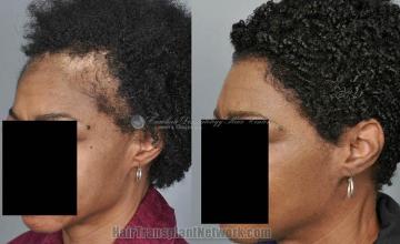 Hair restoration procedure before and after pictures