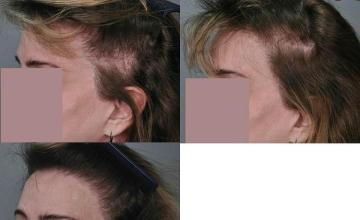 Hair transplantation surgery before and after pictures