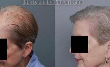 Hair restoration procedure results