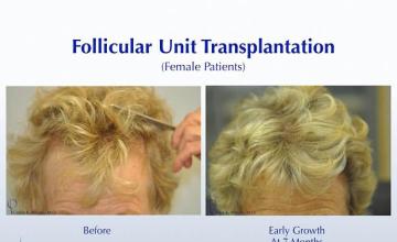 Hair restoration procedure before and after results