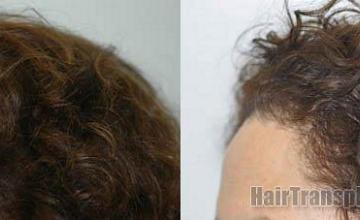 Hair restoration procedure results