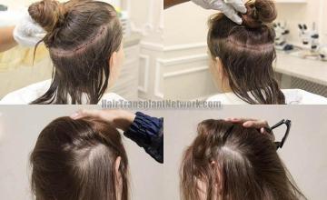 Hair restoration procedure before and after pictures