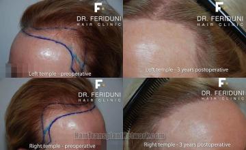 Hair restoration surgery before and after photos