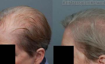 Left view before and after hair transplantation on female