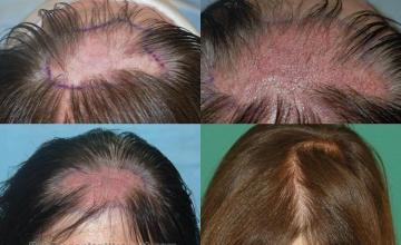 Hair restoration procedure before and after pictures