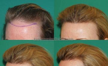 Hair restoration procedure before and after pictures