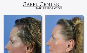 Hair restoration surgery before and after photos