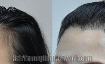 Hair transplantation surgery before and after images