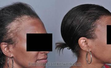 Hair transplantation surgery before and after images