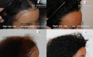 Hair transplantation surgery before and after images