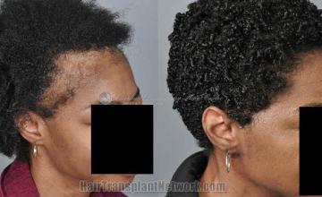 Hair transplantation surgery before and after images