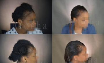 Female hair transplantation procedure before and after result