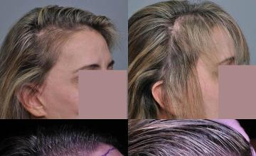 Hair restoration procedure before and after results