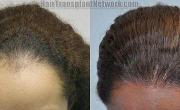 Female - top view before and after hair restoration results