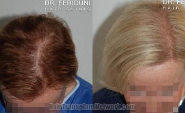 Hair transplantation surgery before and after photos