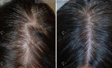 Female hair transplantation surgery before and after images